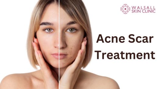 acne-scar-treatment
